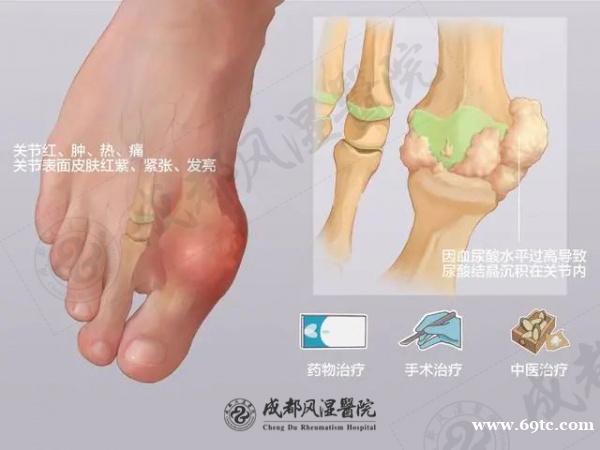 工作压力大也是诱发痛风的元凶 工作压力大也是诱发痛风的元凶