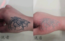 激光洗纹身价格实惠效果看的见